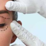 que es la blefaroplastia y en que consiste
