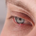 chalazion