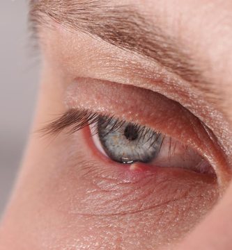 chalazion