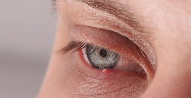 chalazion