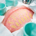 Guía Médica de las Glándulas de Meibomio: Función, Disfunción (DGM) y Cuidado Palpebral