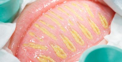 Guía Médica de las Glándulas de Meibomio: Función, Disfunción (DGM) y Cuidado Palpebral